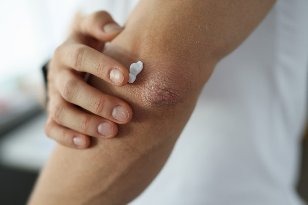 Man applying protective cream to damaged skin of elbow close-up